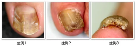 爪水虫 爪白癬の治療 たく皮フ科